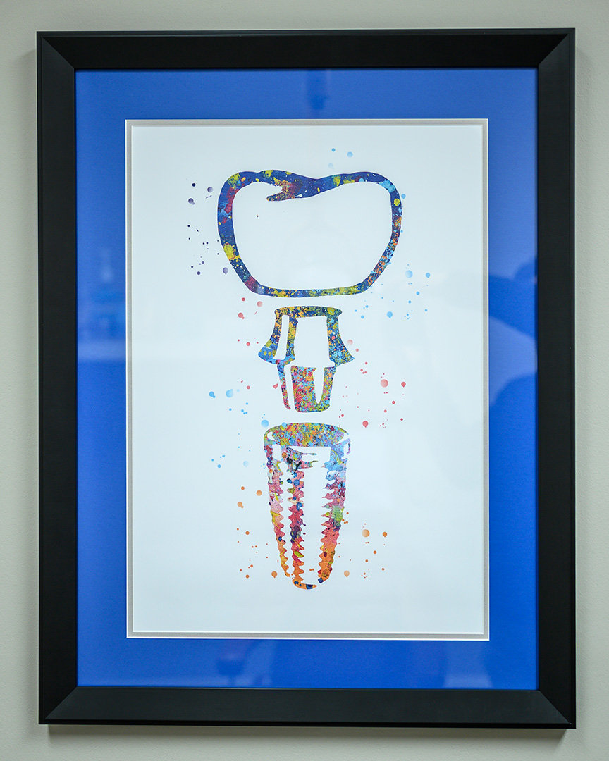 A painting portraying a dental implant from the All-on-4 implant procedure at LaGrange Oral Surgery and Implant Center.