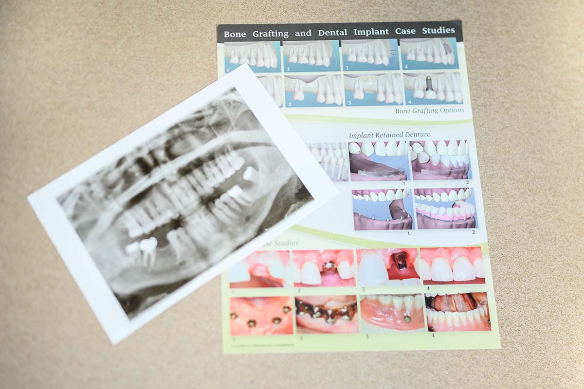 An informational packet about bone grafting and dental implants at LaGrange Oral Surgery.