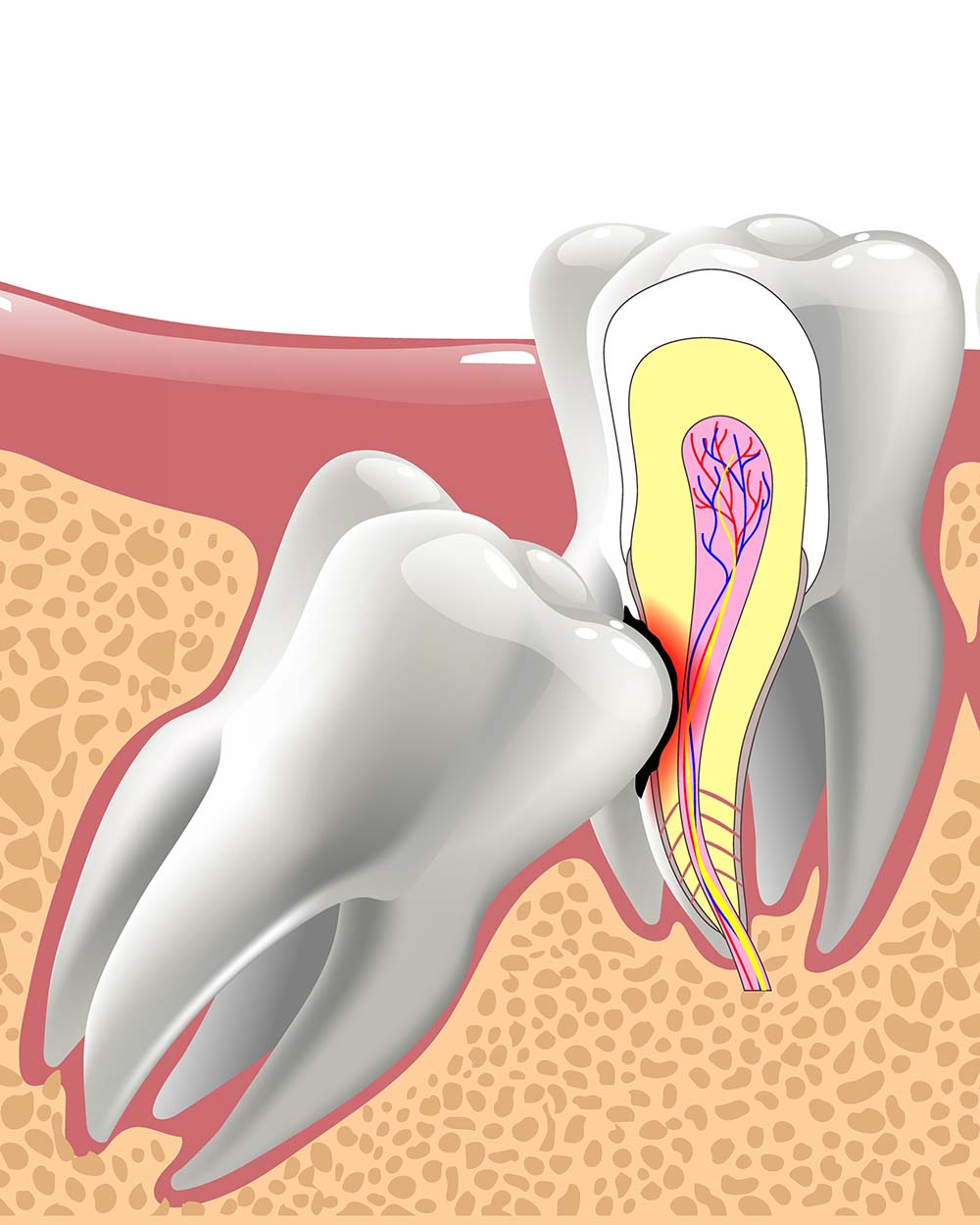 A graphic representation of an impacted wisdom tooth and nerves.