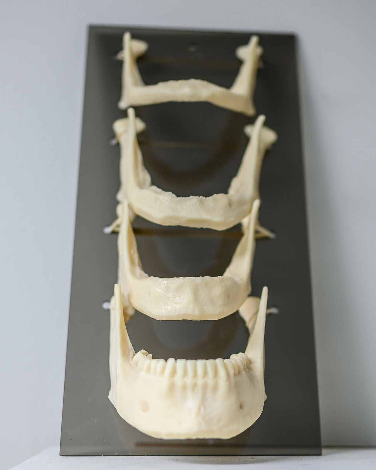 Jaw models are on display at LaGrange Oral Surgery and Implant Center.