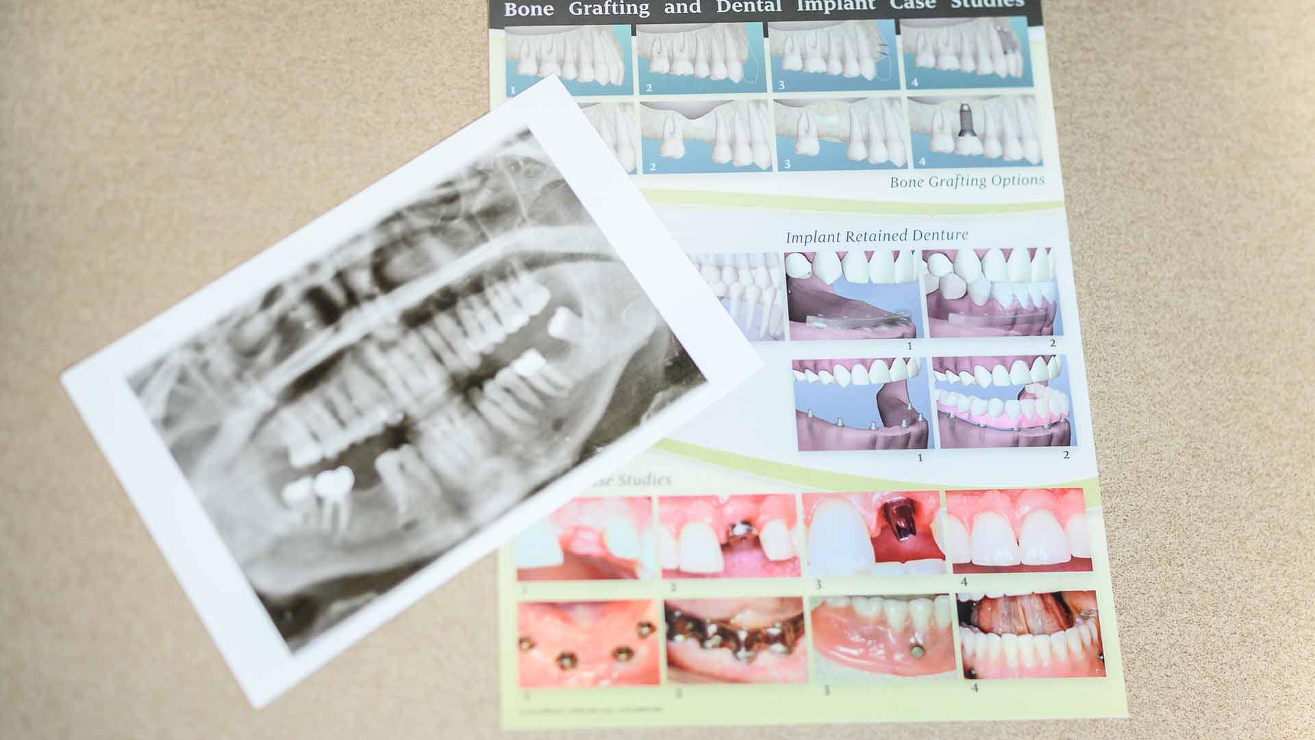 Graphic representations of different oral surgery procedures at LaGrange Oral Surgery and Implant Center.