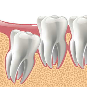 A graphic representation of an impacted tooth.