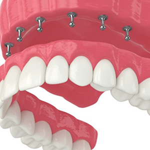 A graphic representation of implant dentures.