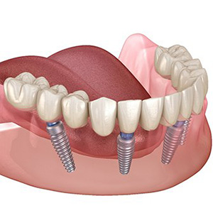A graphic representation of All-on-4 dental implants.